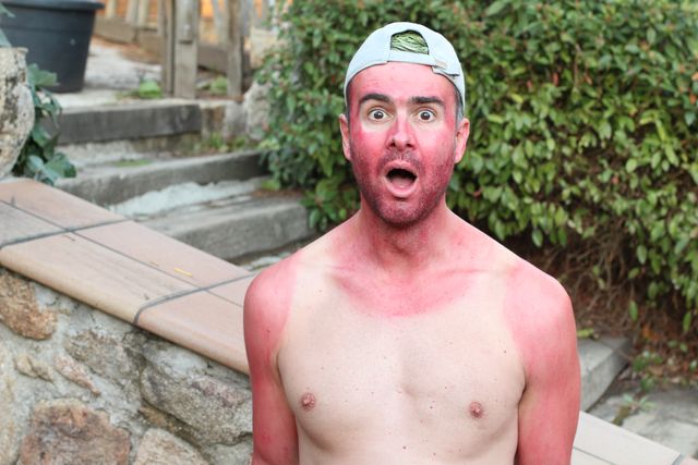 sunburned young man with extreme tan lines