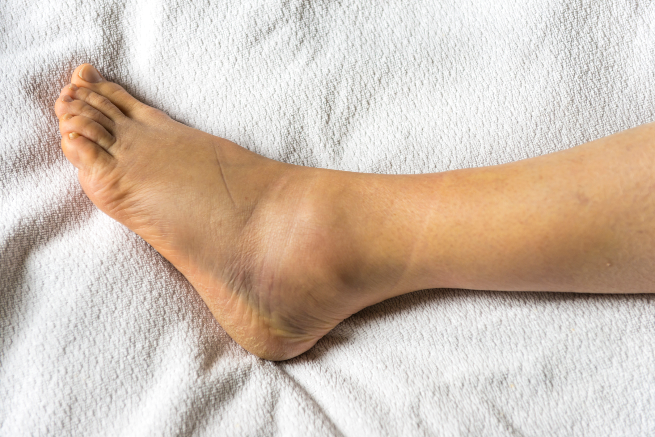 10 Causes for Swollen Feet - Why Your Feet, Ankles, Legs Swell