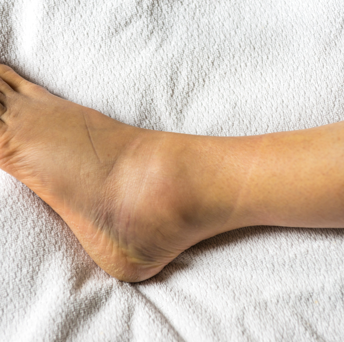 12 Causes of Swollen Ankles, Feet - Why Are My Ankles Swollen