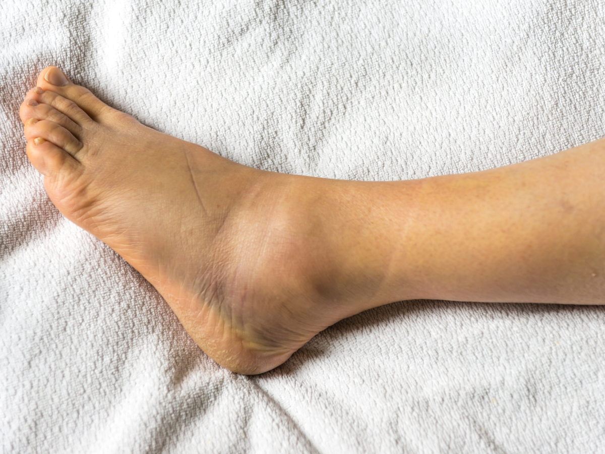 How to Heal a Ankle Injury using Sprain Ankle Treatment