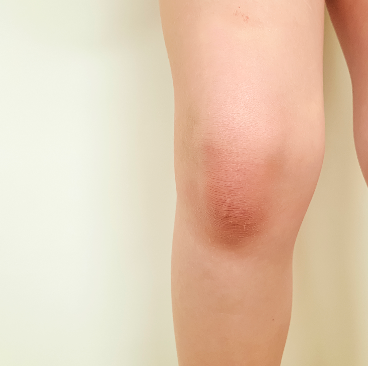 Knee Pain on Outside of Joint: Four Reasons Why