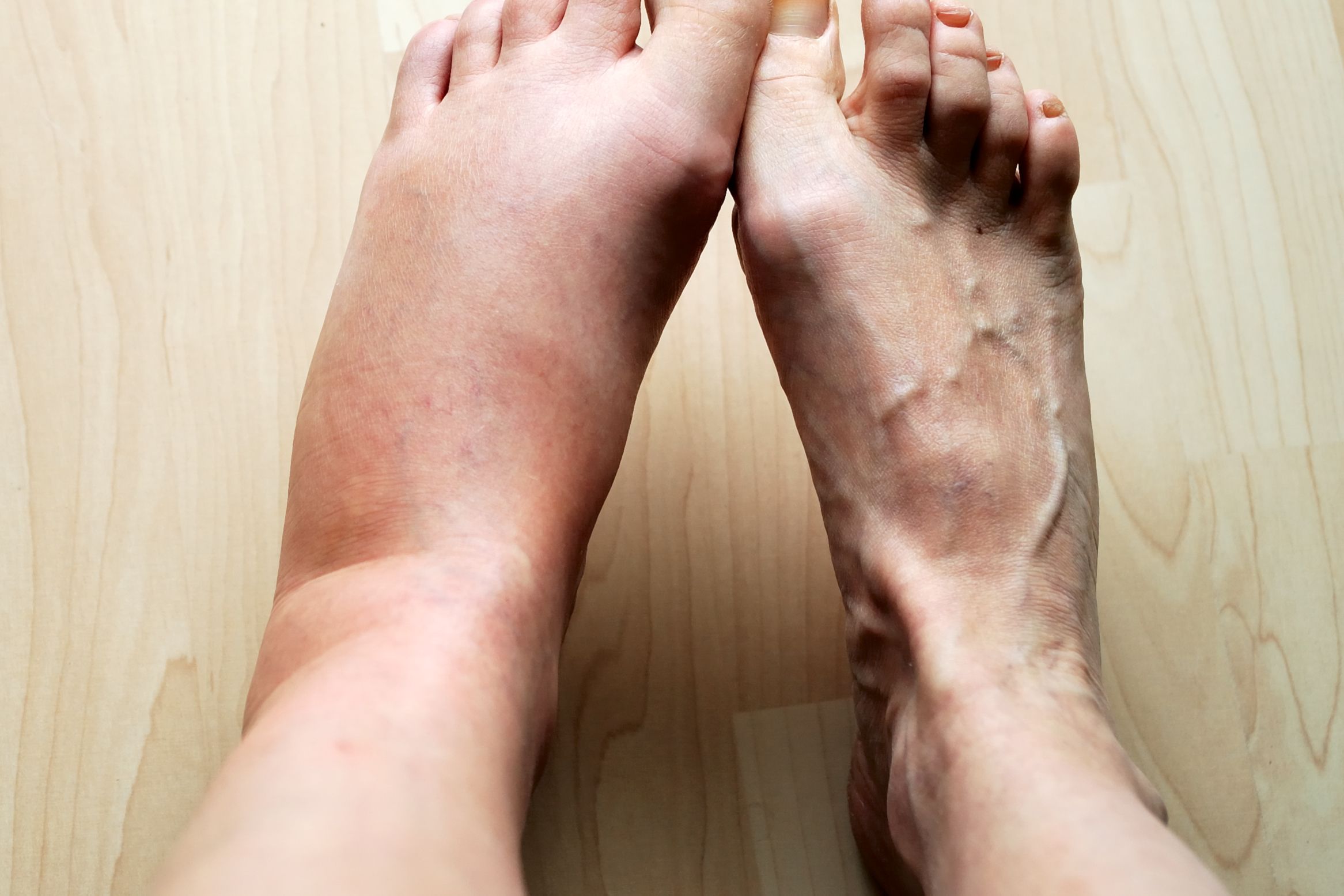 10 Causes for Swollen Feet pic
