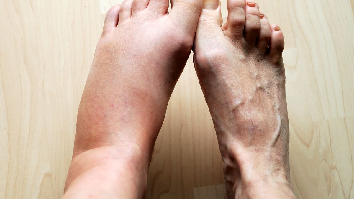 Could My Swollen Feet Be Tied To My Diet?