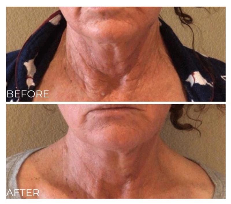 how to make your neck look younger