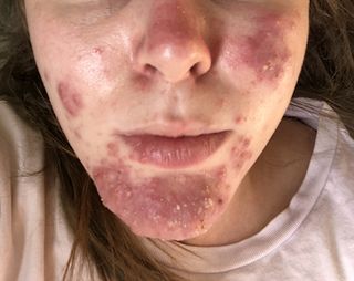 kabine Beskrivelse Med andre band Roaccutane: What It's Like to Take the Acne-control Medication