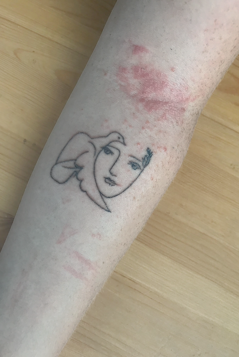 tattoo allergic reaction