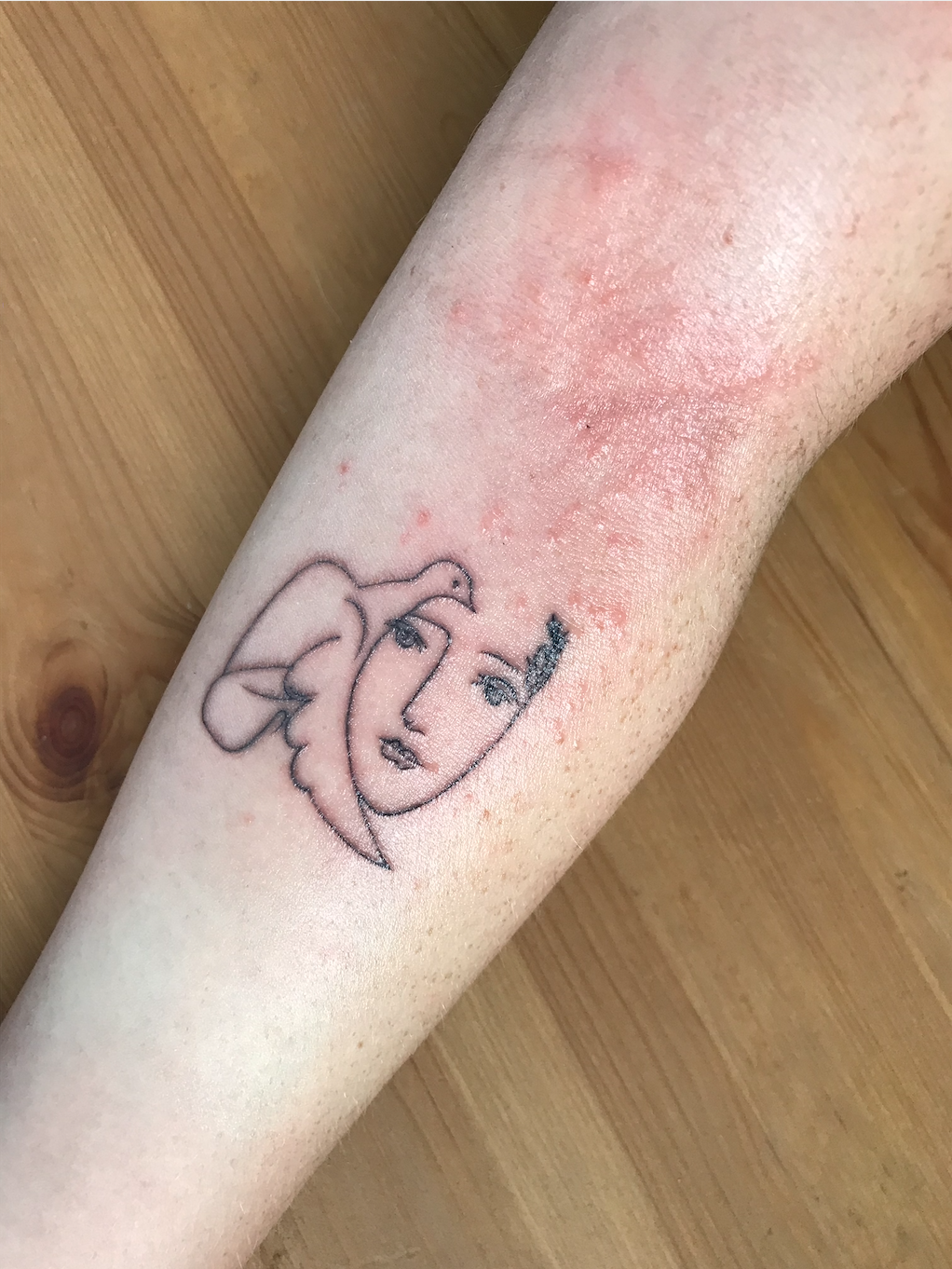Is it normal to get a rash after a tattoo