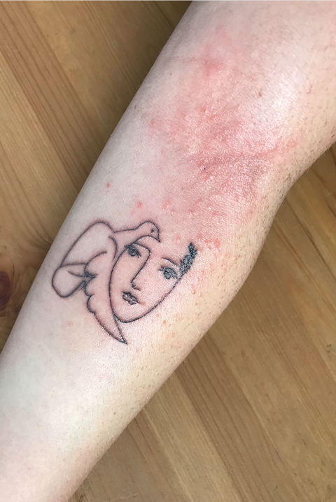 tattoo allergic reaction rash