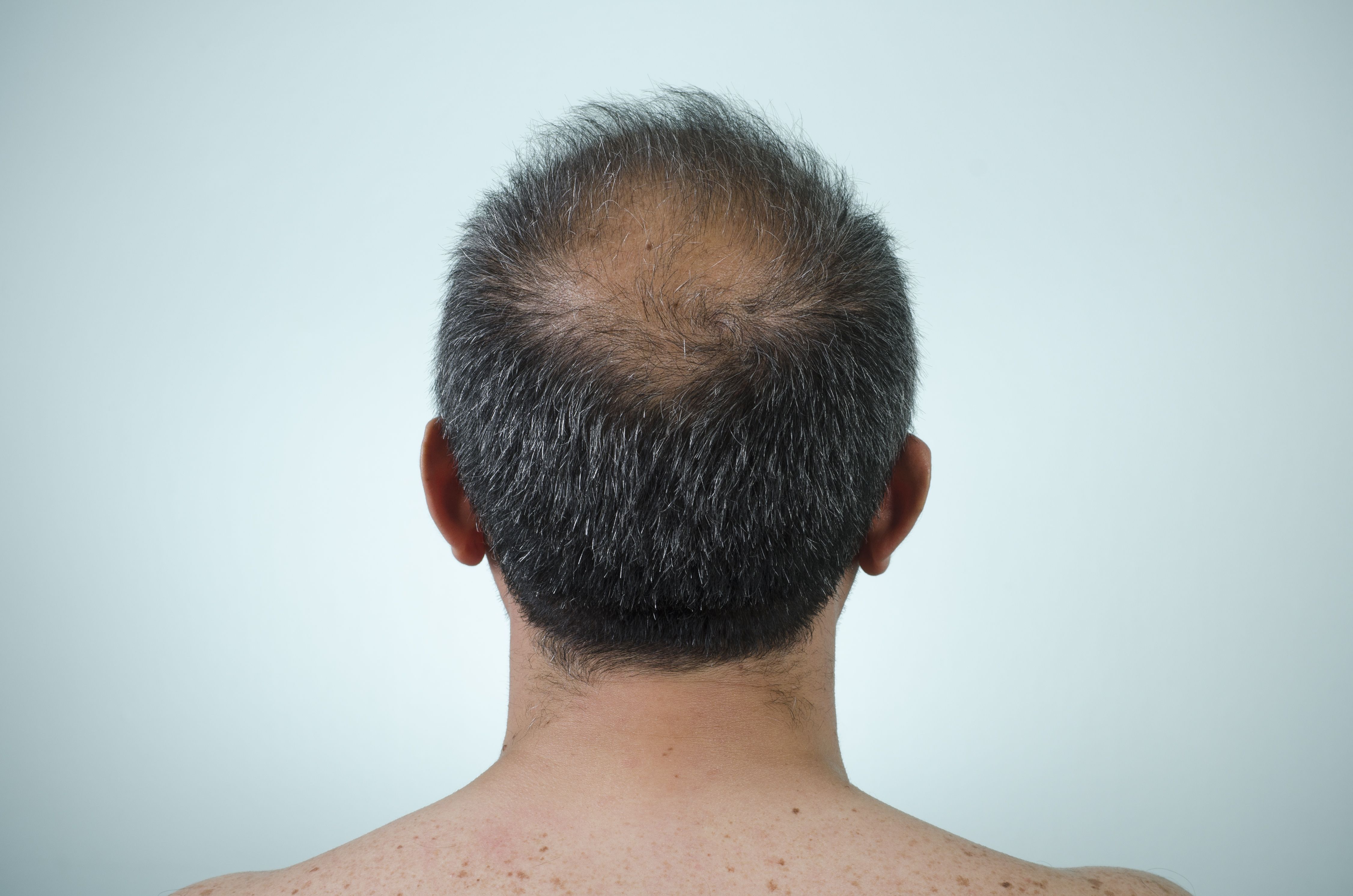 What causes balding in the back of the head?