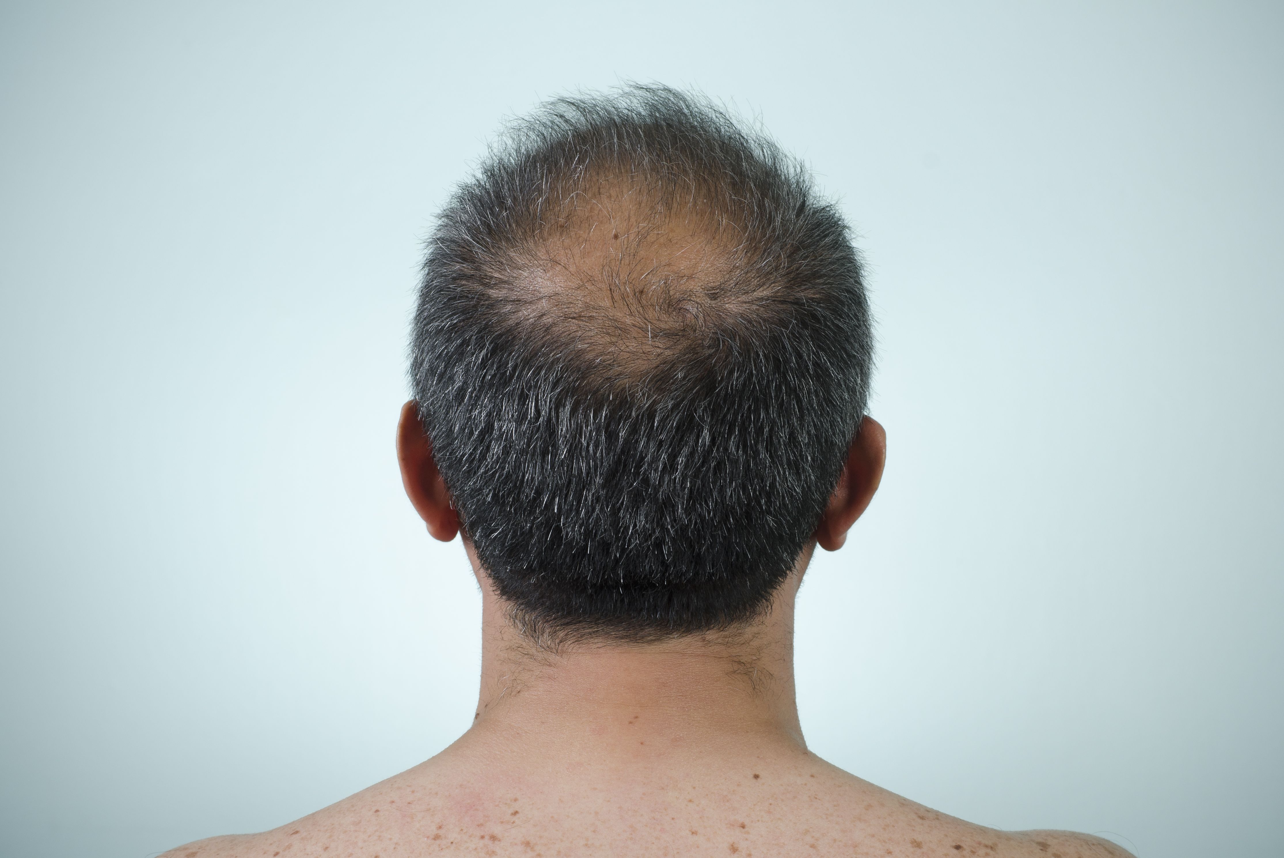 crown of head hair loss