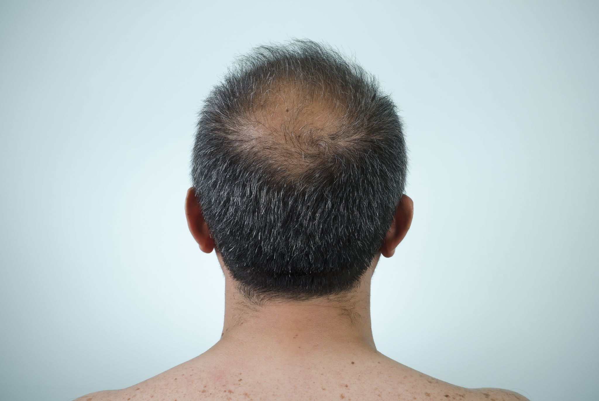 https://hips.hearstapps.com/hmg-prod/images/the-back-view-of-a-mans-head-who-is-balding-royalty-free-image-184378269-1547650617.jpg?crop=0.990xw:1.00xh;0.00518xw,0&resize=2048:*