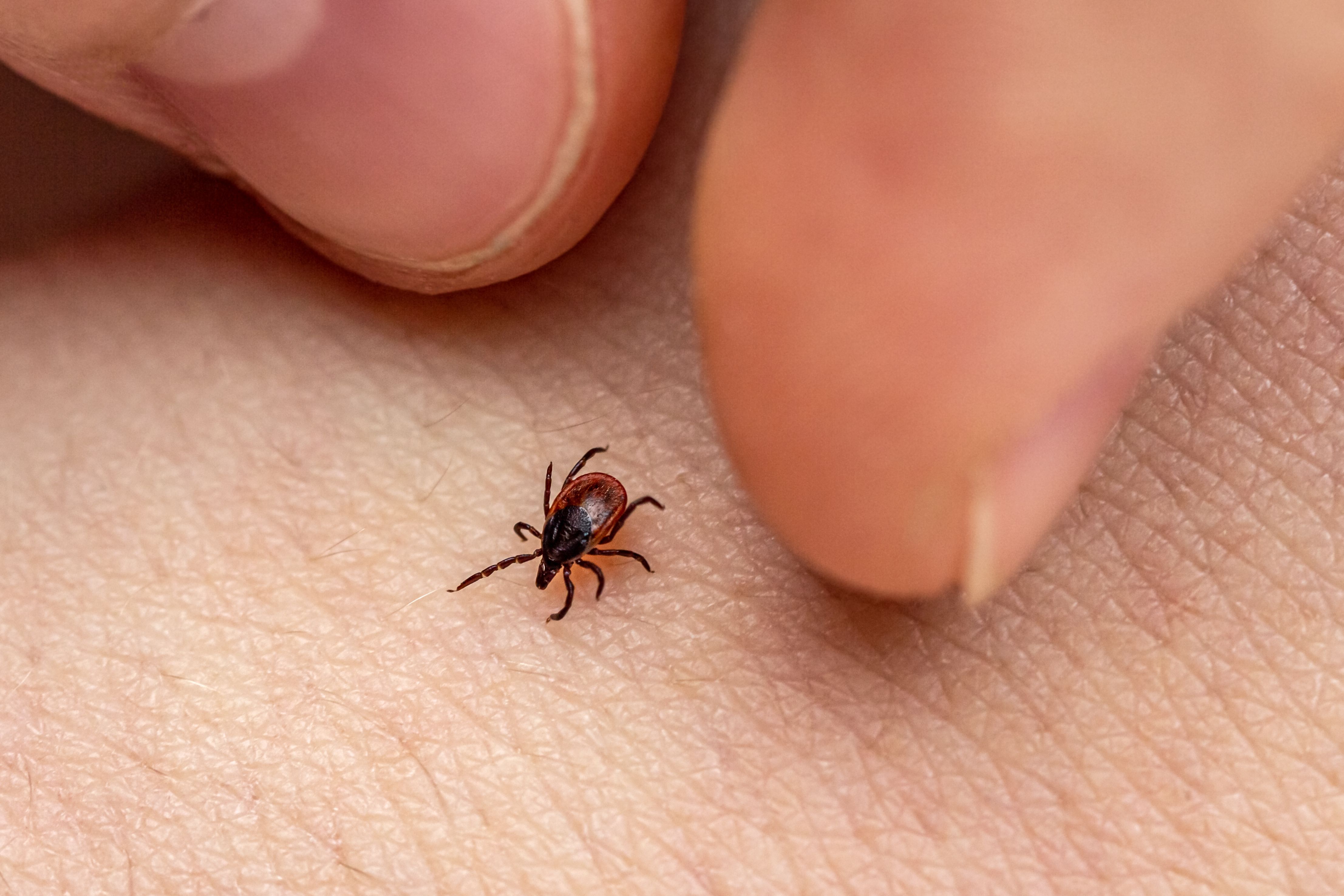 How to Remove a Tick Head Stuck in Your Skin picture