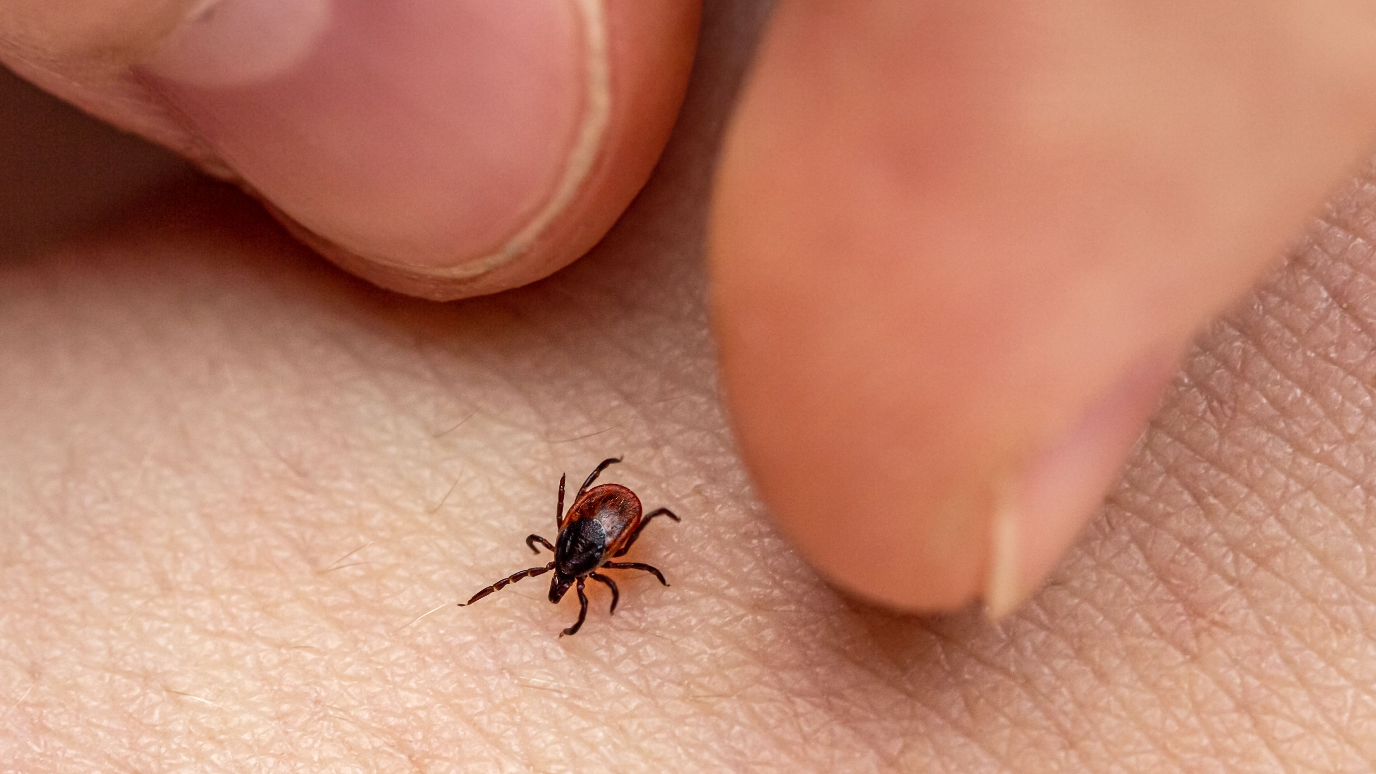How to Remove a Tick Head Stuck in Your Skin - Tick Head Removal Steps