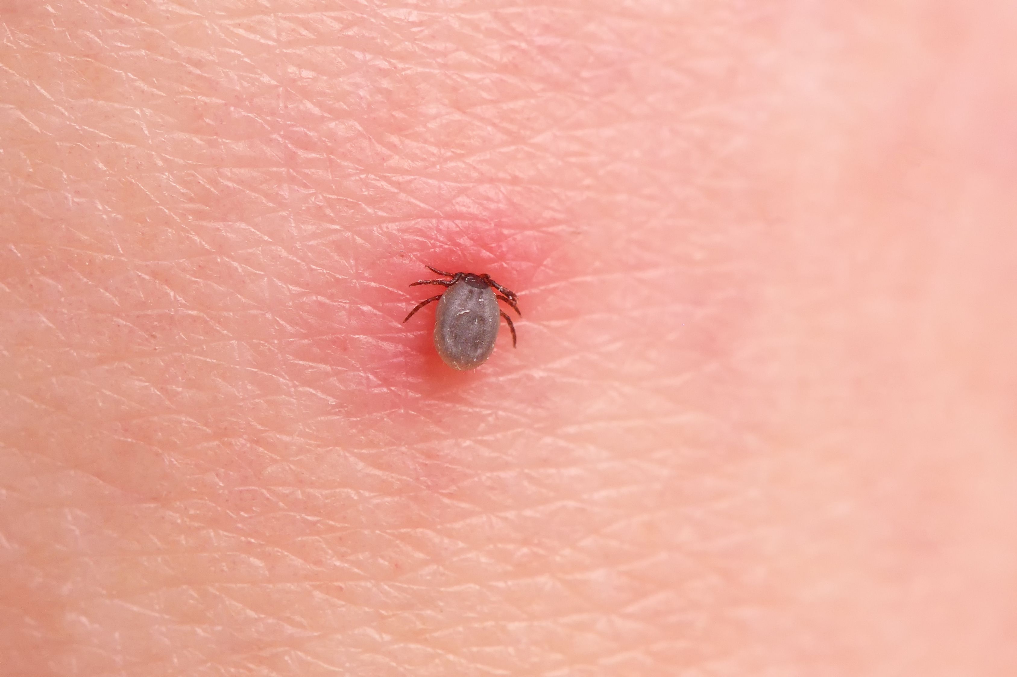 Tick bites - symptoms, treatments and prevention
