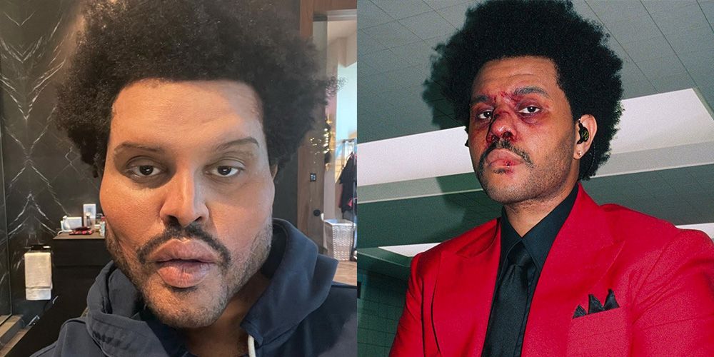 Did The Weeknd Get Plastic Surgery? Transformation Photos