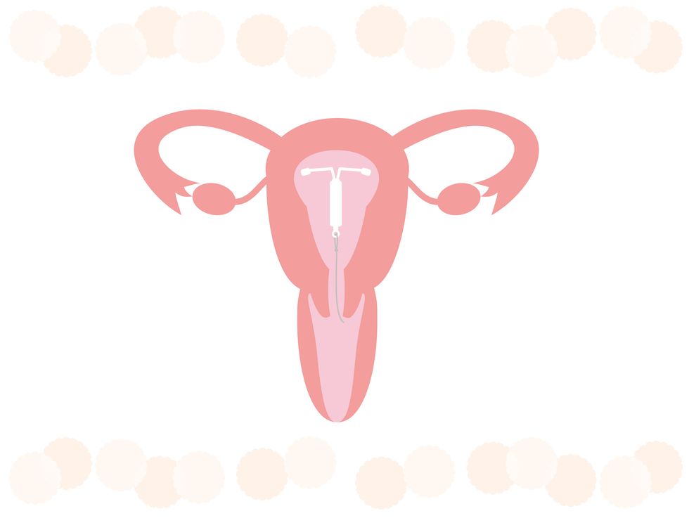 this is an illustration of an iud  intrauterine device