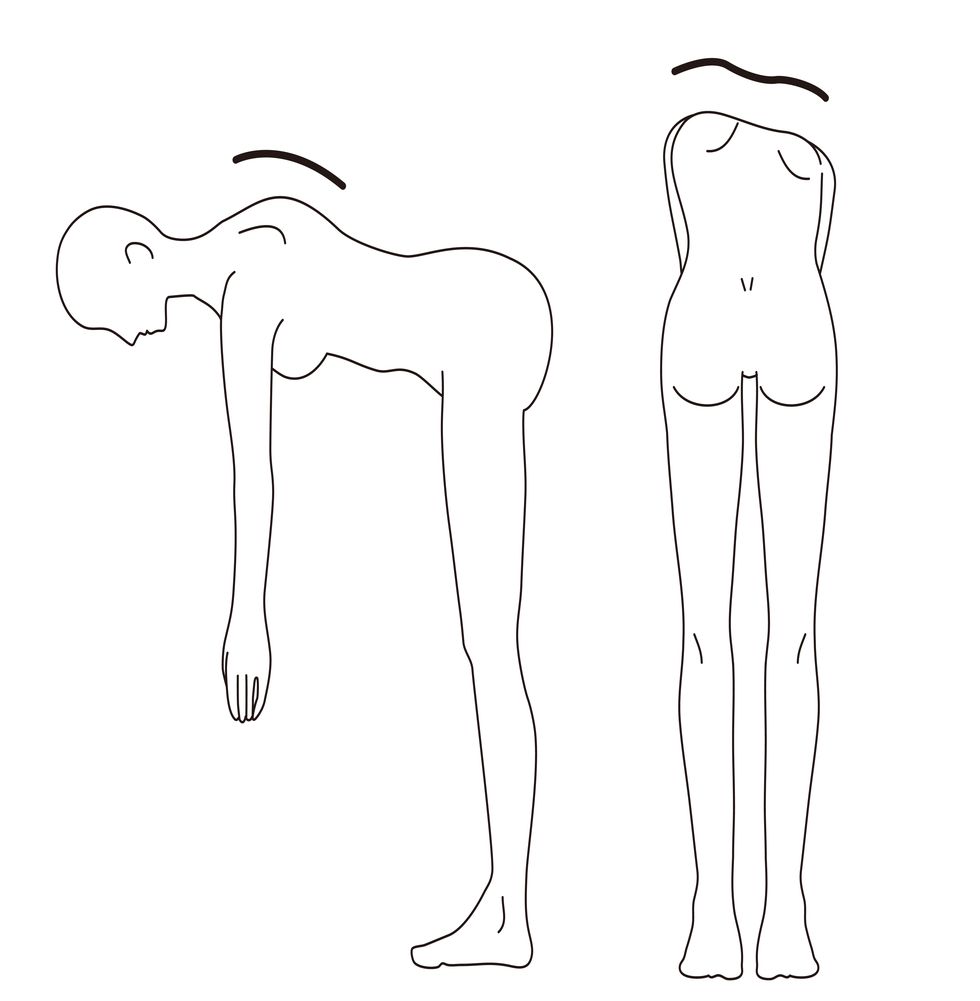 this is an illustration of checking if you have scoliosis