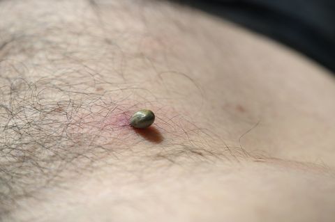 tick ​​attached to the skin of a mans stomach and sucking blood