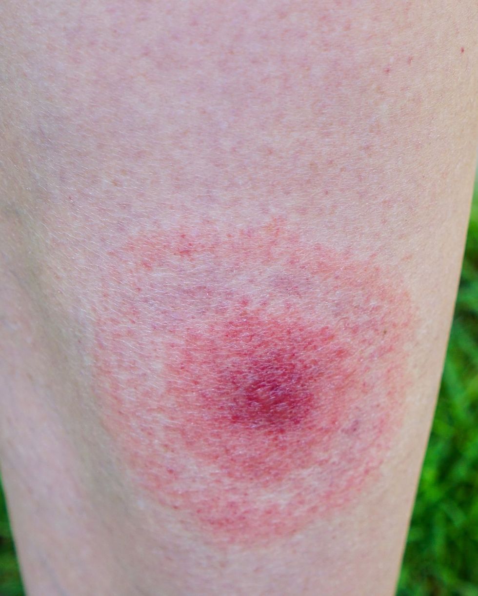 15 Common Bug Bite Pictures - How To Id Insect Bites And Stings