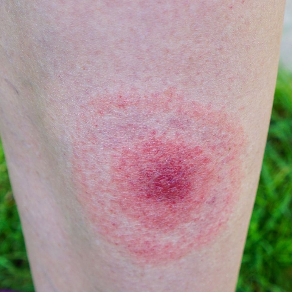 what do tick bites look like