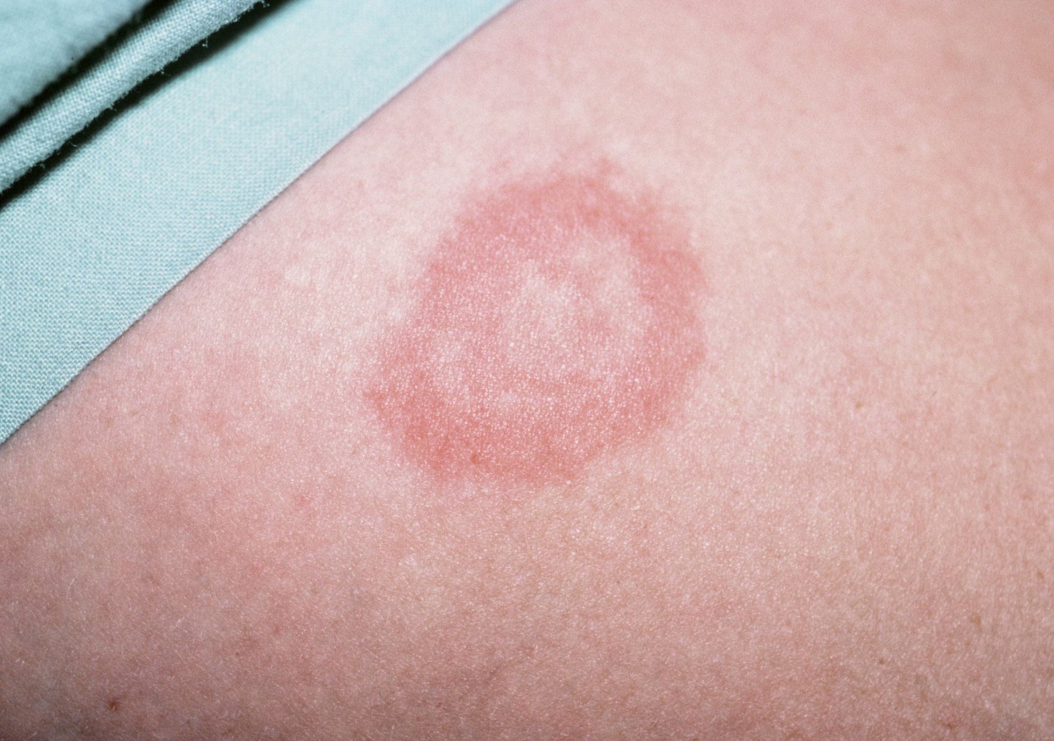 Ringworm, Facial (Tinea Faciei) Condition, Treatments and Pictures for  Teens - Skinsight