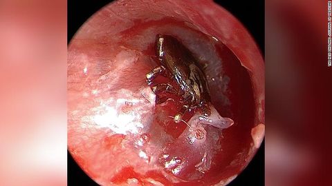 tick in ear case study