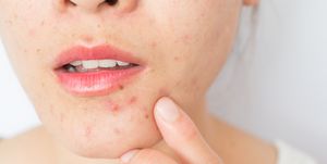 Este vídeo de TikTok te ayuda a ocultar el acné.