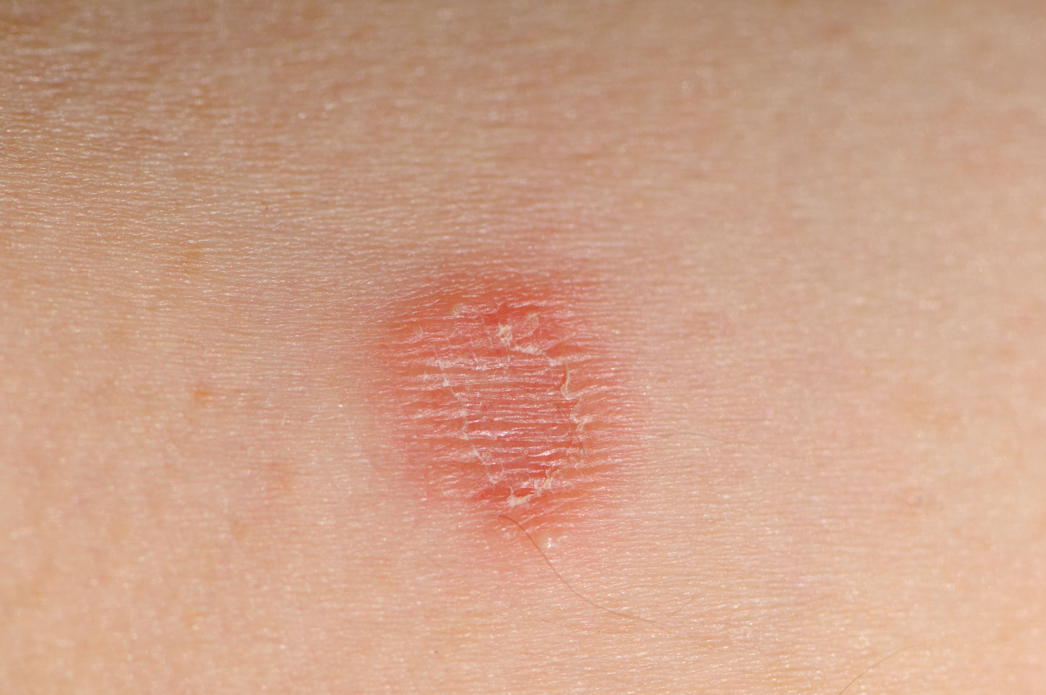 How Would I Know If I Have Ringworm?