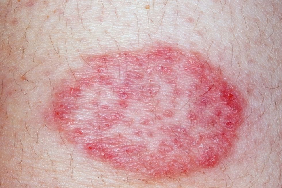Express overrasket Krympe What Do Red Spots On Skin Mean? 13 Skin Spots & Bumps Pictures