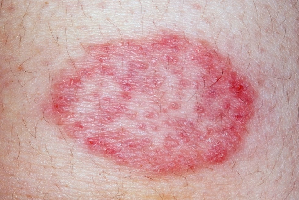 tinea infection