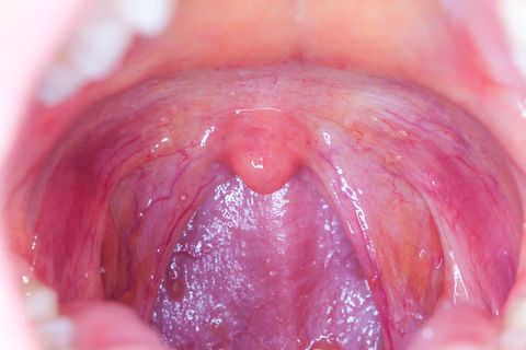 tonsilitis infection throat.macro opened mouth throat  tonsil
