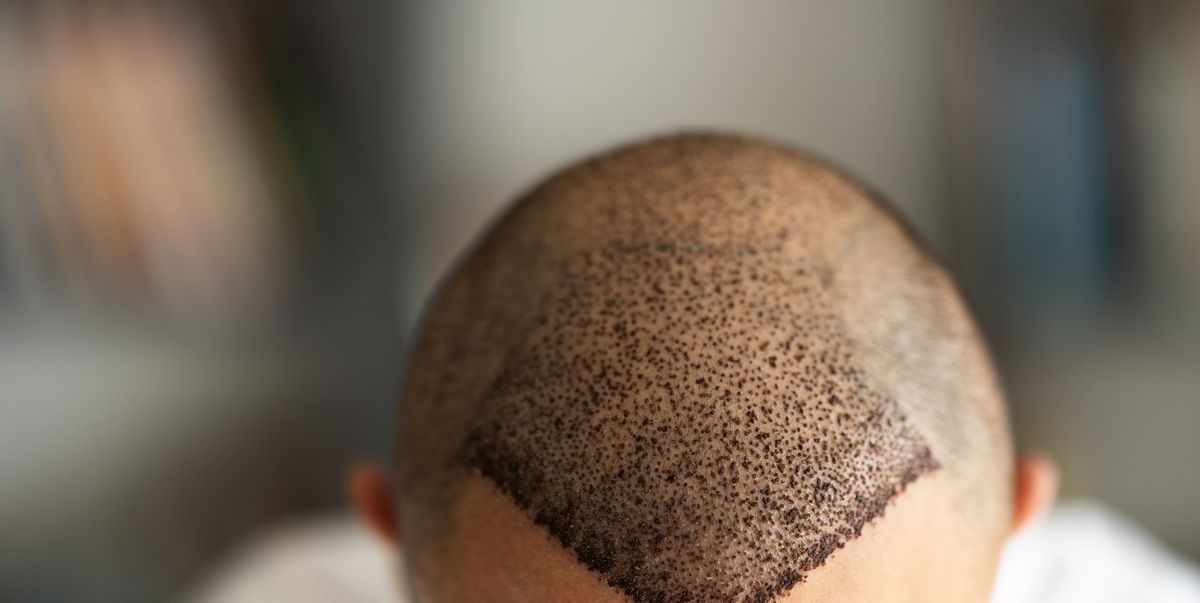 Is a Hair Transplant Right for You? The Crucial Timing Advice You Need, According to a Surgeon