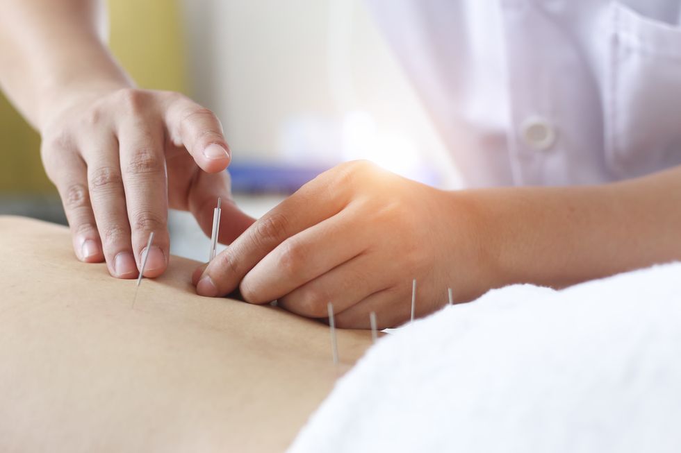 traditional chinese medicine treatment   acupuncture,acupuncture