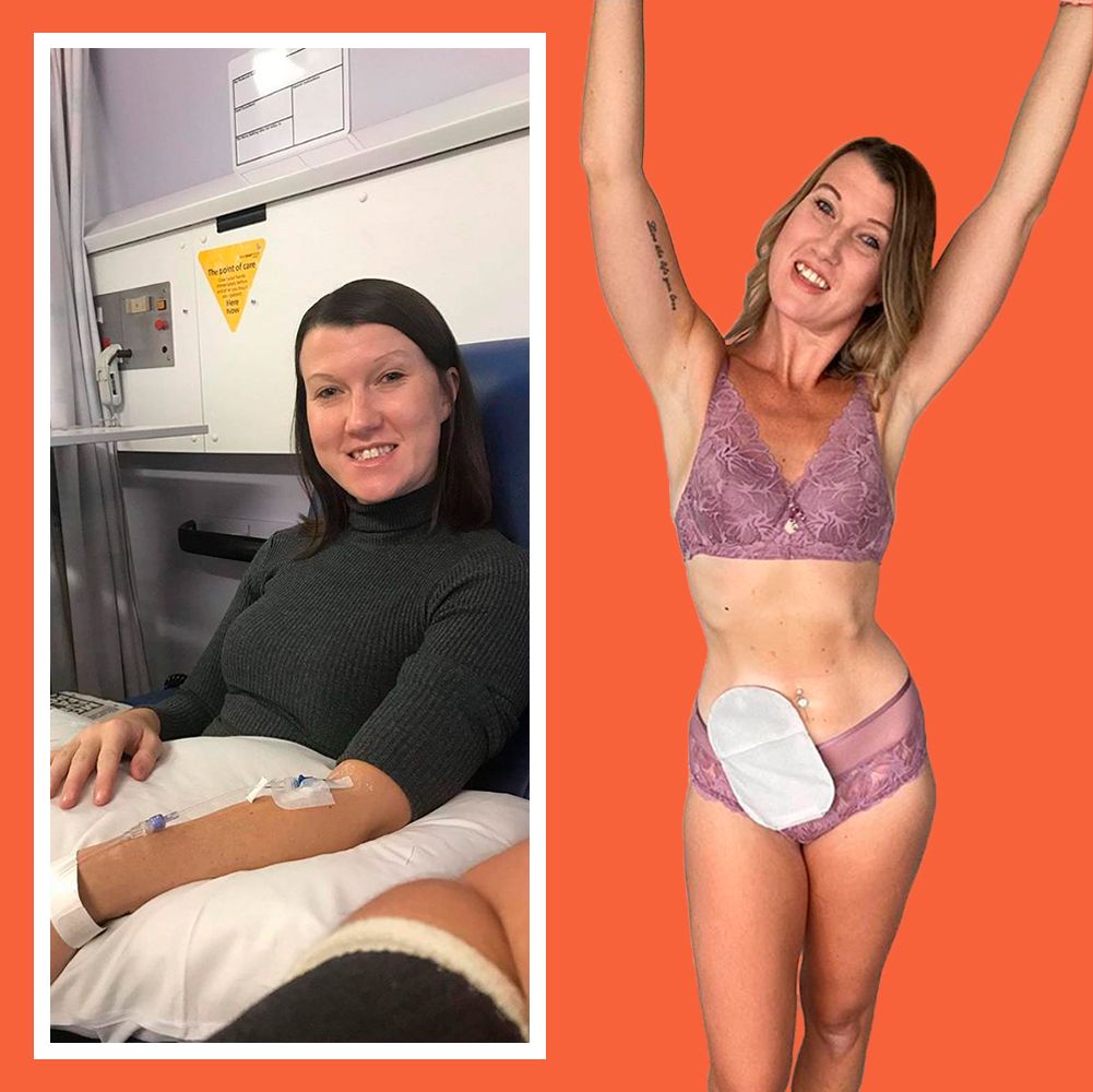 Changing your colostomy bag