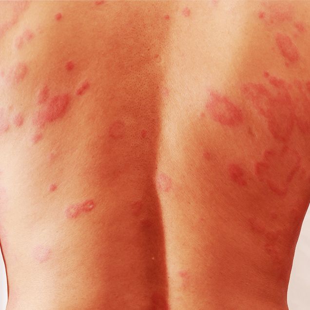 How to get rid of heat rash: Relieve redness and itchiness by
