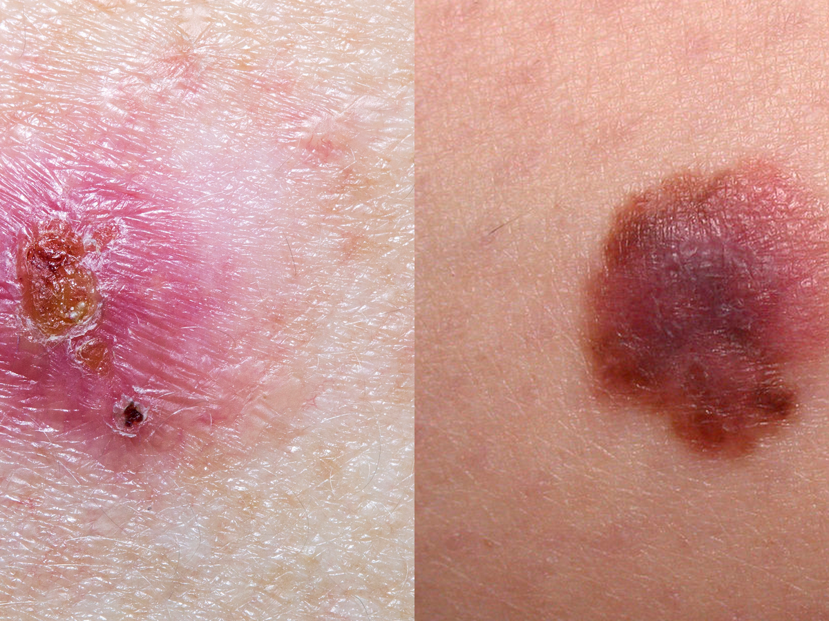 Skin cancer on leg: Appearance and more