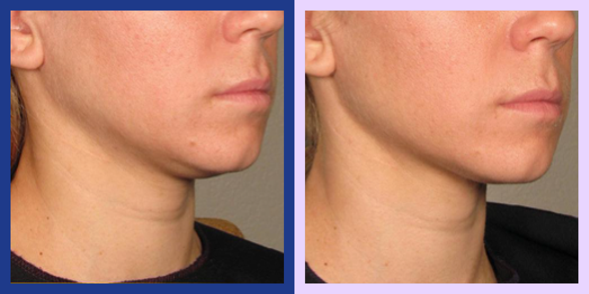 Rj Clinic Ultherapy