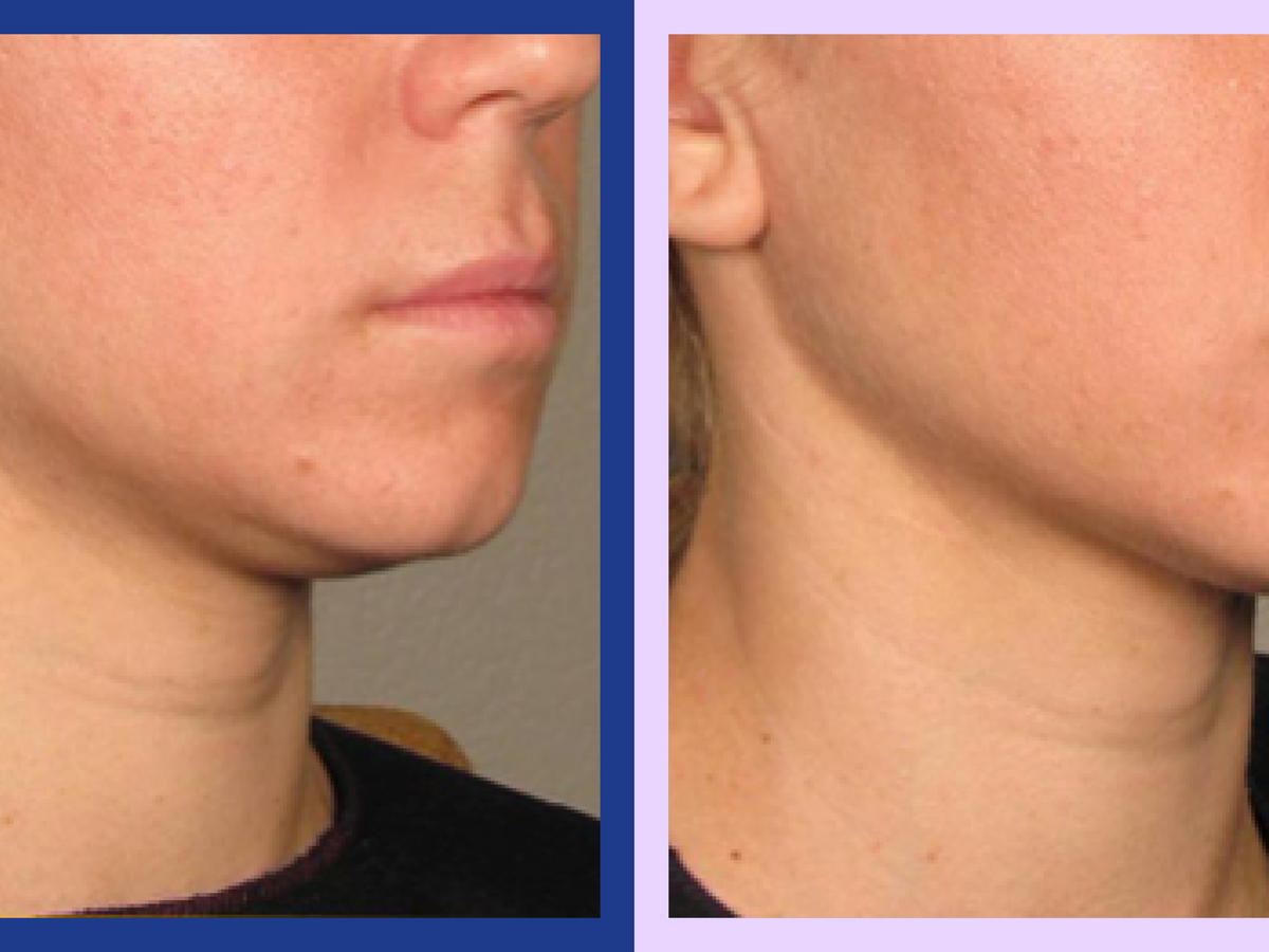 Rj Clinic Ultherapy