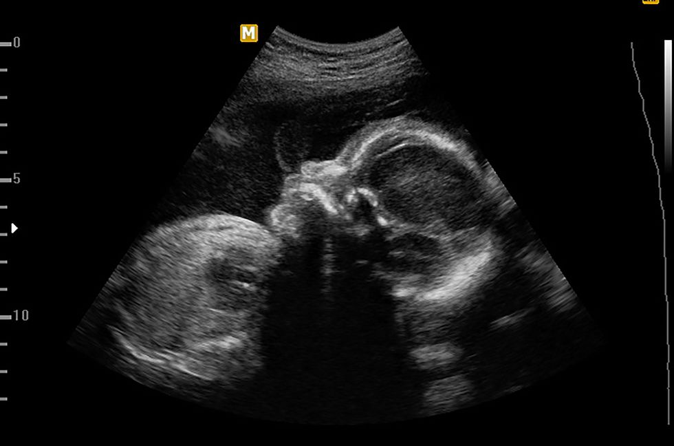 ultrasound of baby in pregnant woman, doctor reading test results of pregnant woman by ultrasound