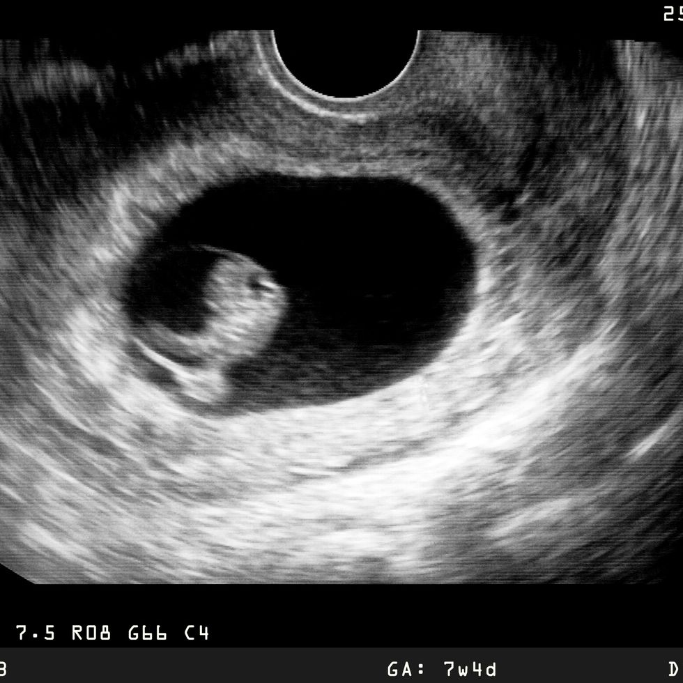 ultrasound showing early stage of embryo development