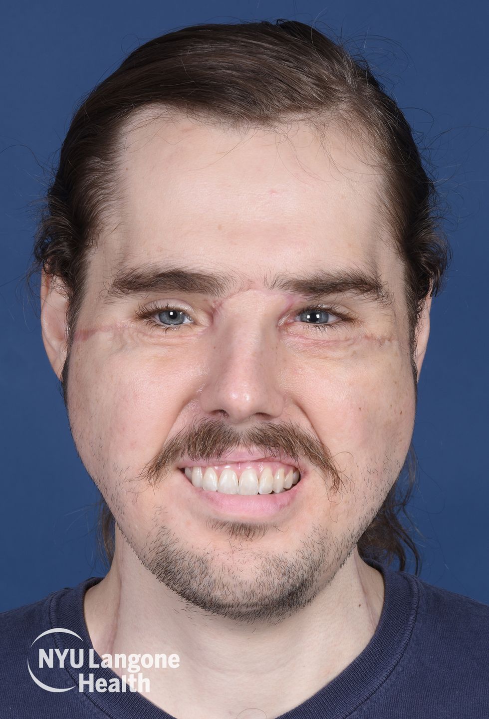 cameron underwood face transplant 