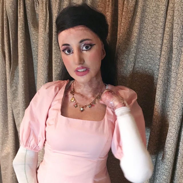 epidermolysis bullosa