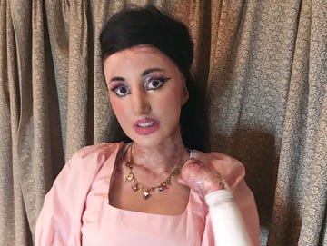 epidermolysis bullosa epidermolysis bullosa