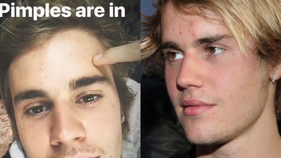 Justin Bieber Shares Post-Facial Selfie Wearing Pimple Patches