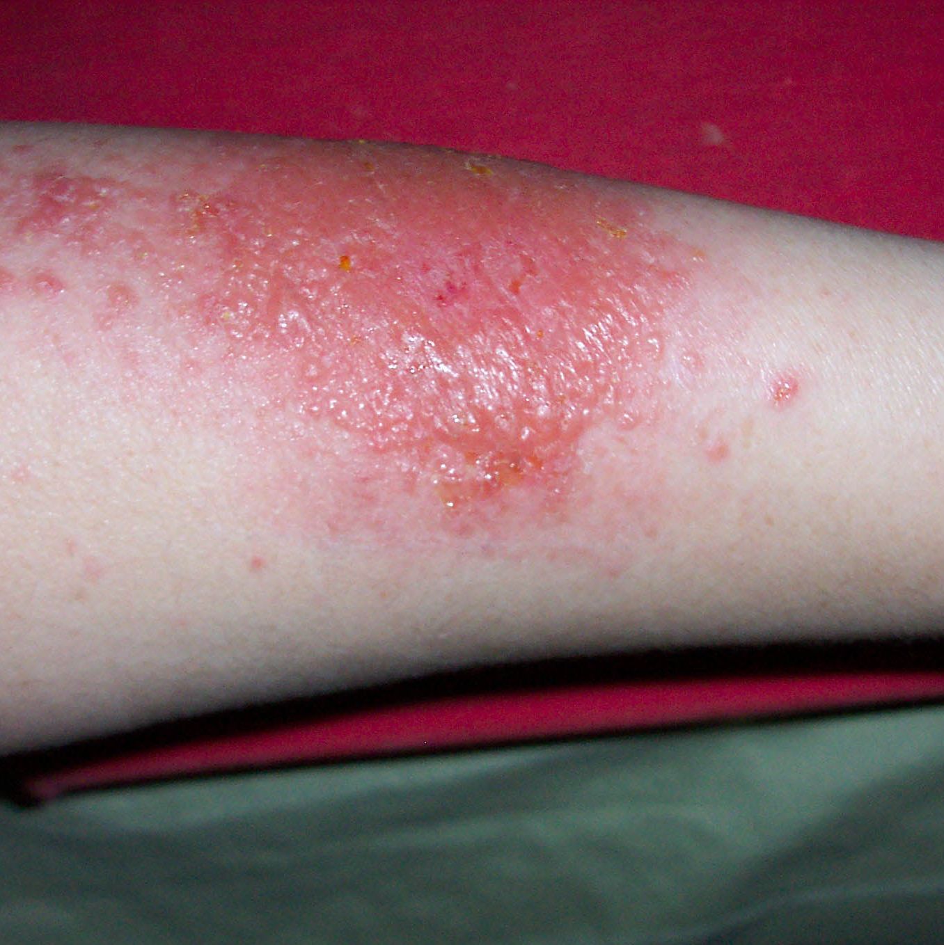 flat red rash on arms