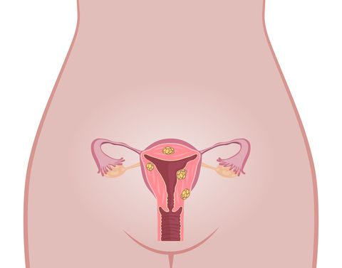 uterine fibroids hysterectomy