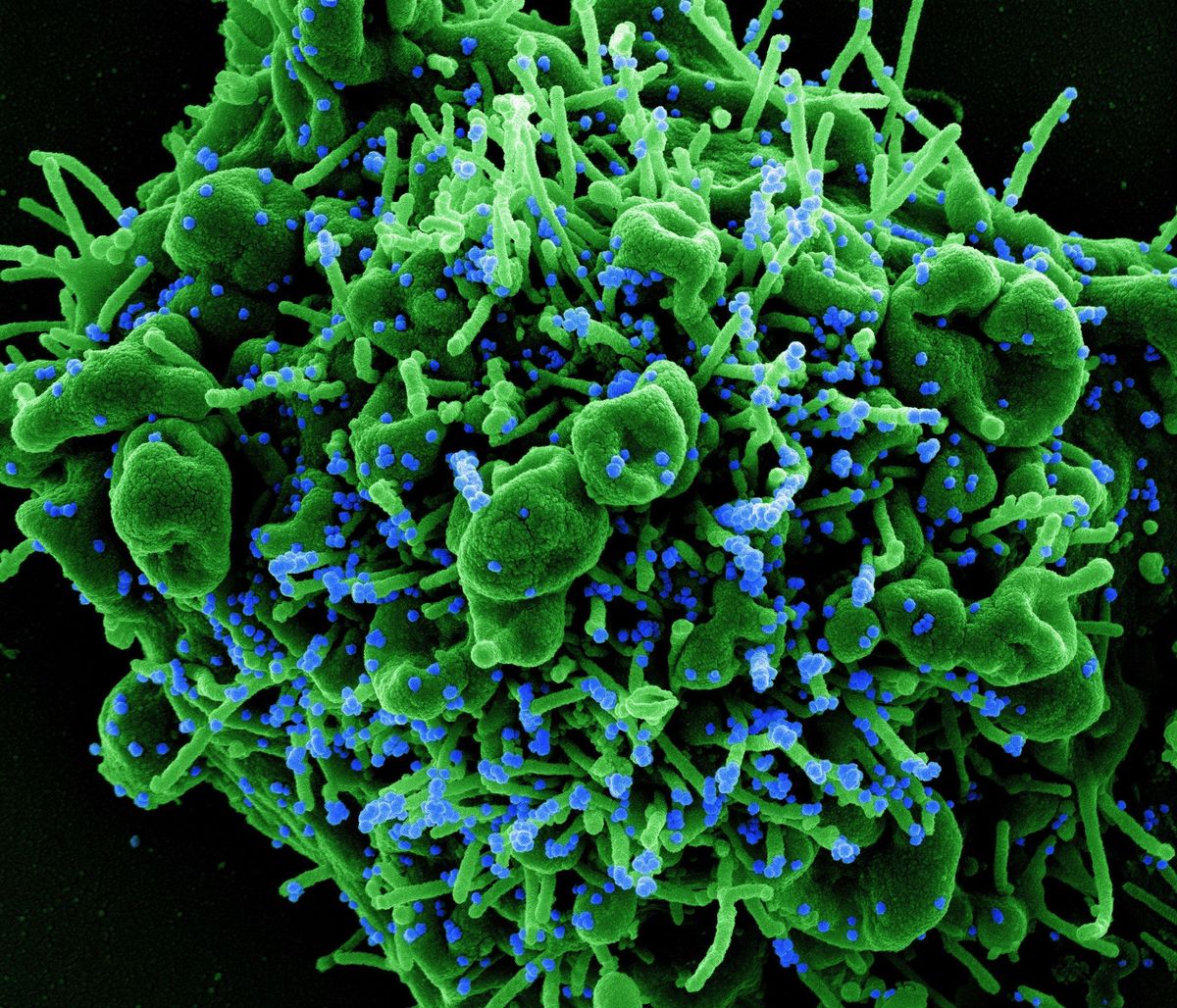 Deze ingekleurde microscoopopname toont een cel groen die is gesoleerd uit het bloed van een COVID19patint De cel is besmet met het SARSCoV2virus blauw en sterft daardoor af