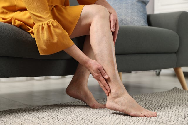 barefoot woman with varicose veins on sofa in room, closeup