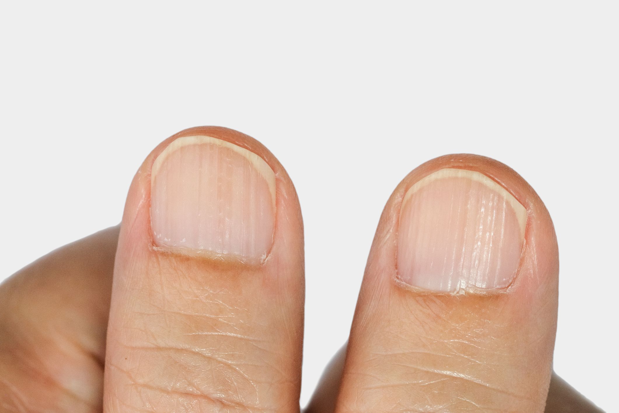 horizontal lines on nails