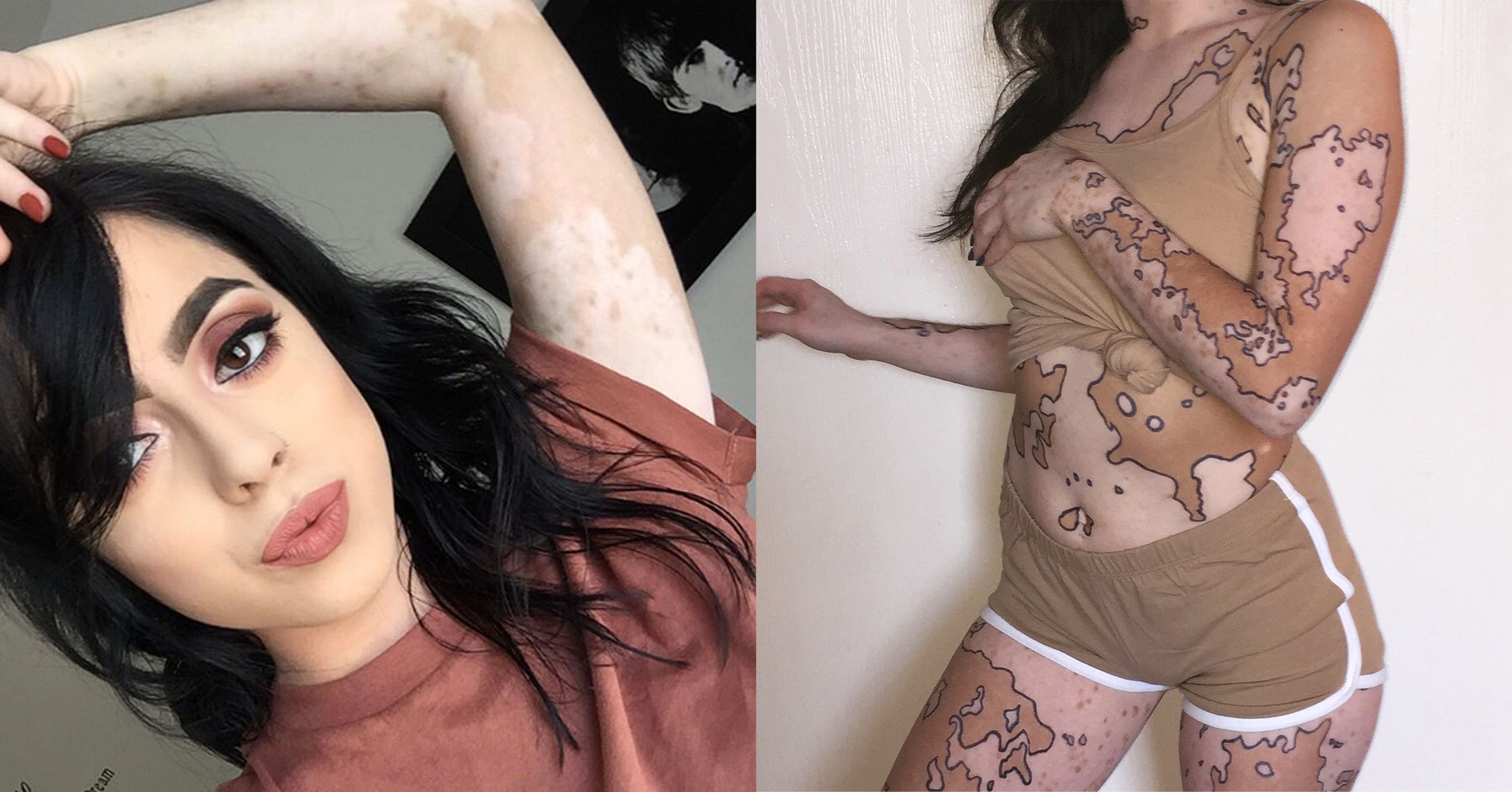 Body Acceptance. Portrait Of Happy Beautiful Lady With Vitiligo